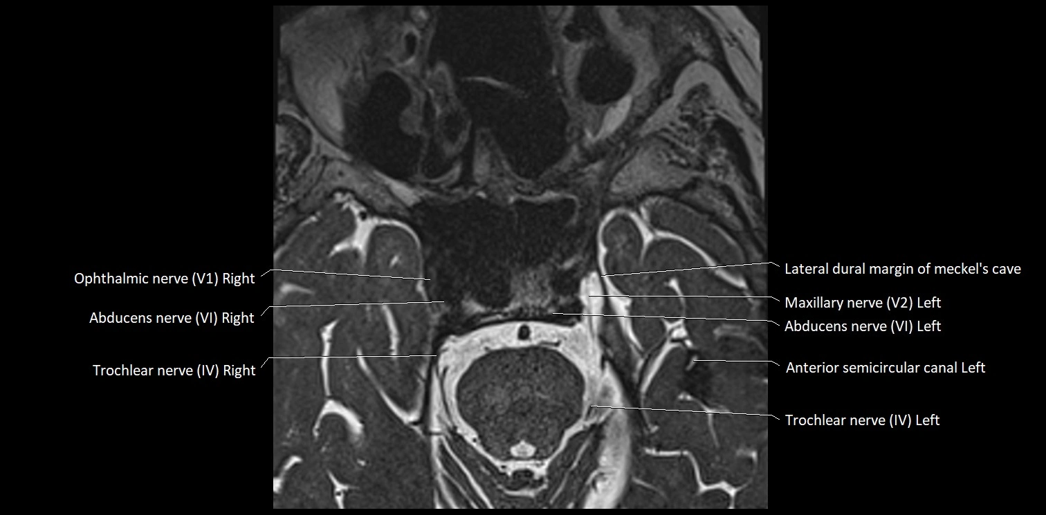 Cranial nerve anatomy axial MRI 3T image 37.webp